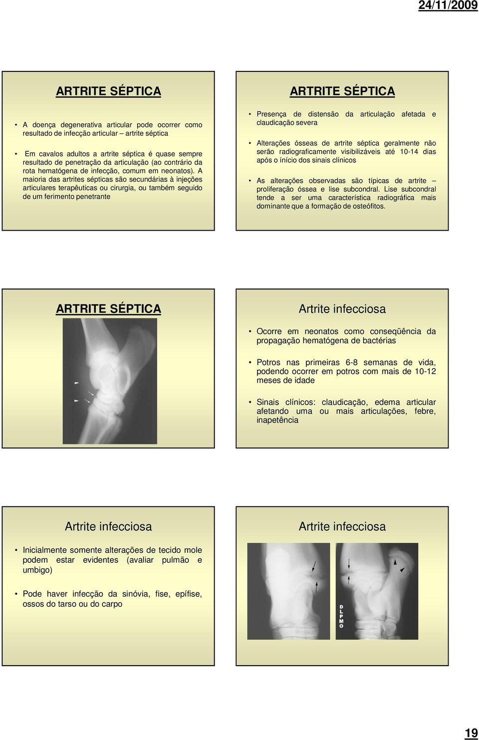 A maioria das artrites sépticas são secundárias à injeções articulares terapêuticas ou cirurgia, ou também seguido de um ferimento penetrante ARTRITE SÉPTICA Presença de distensão da articulação