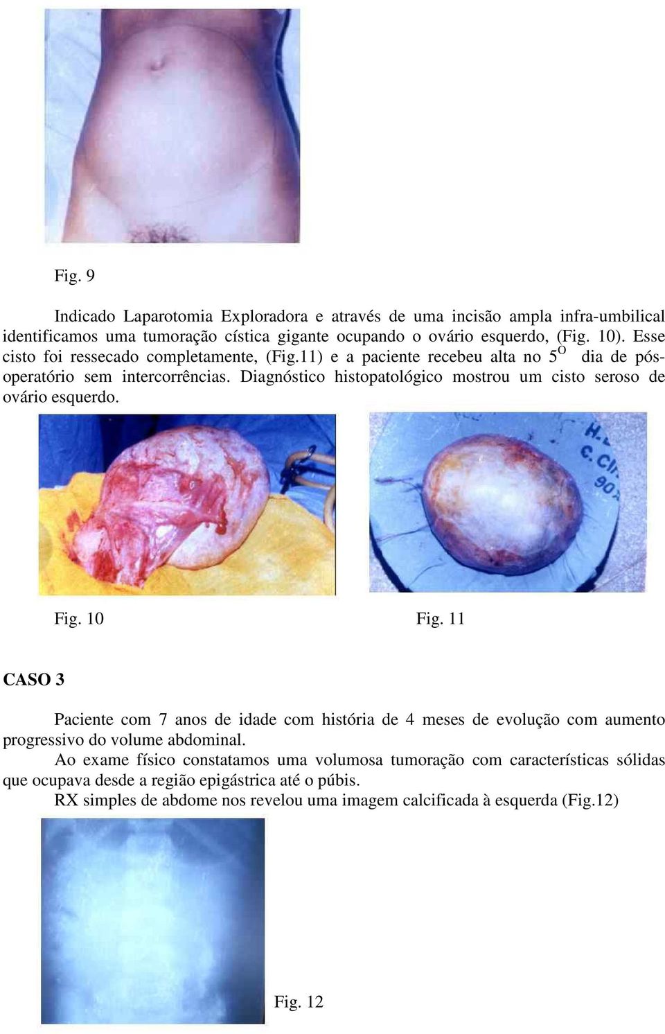 Diagnóstico histopatológico mostrou um cisto seroso de ovário esquerdo. Fig. 10 Fig.