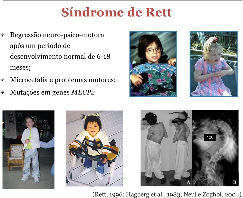 Microcefalia e problemas motores; Mutações em genes