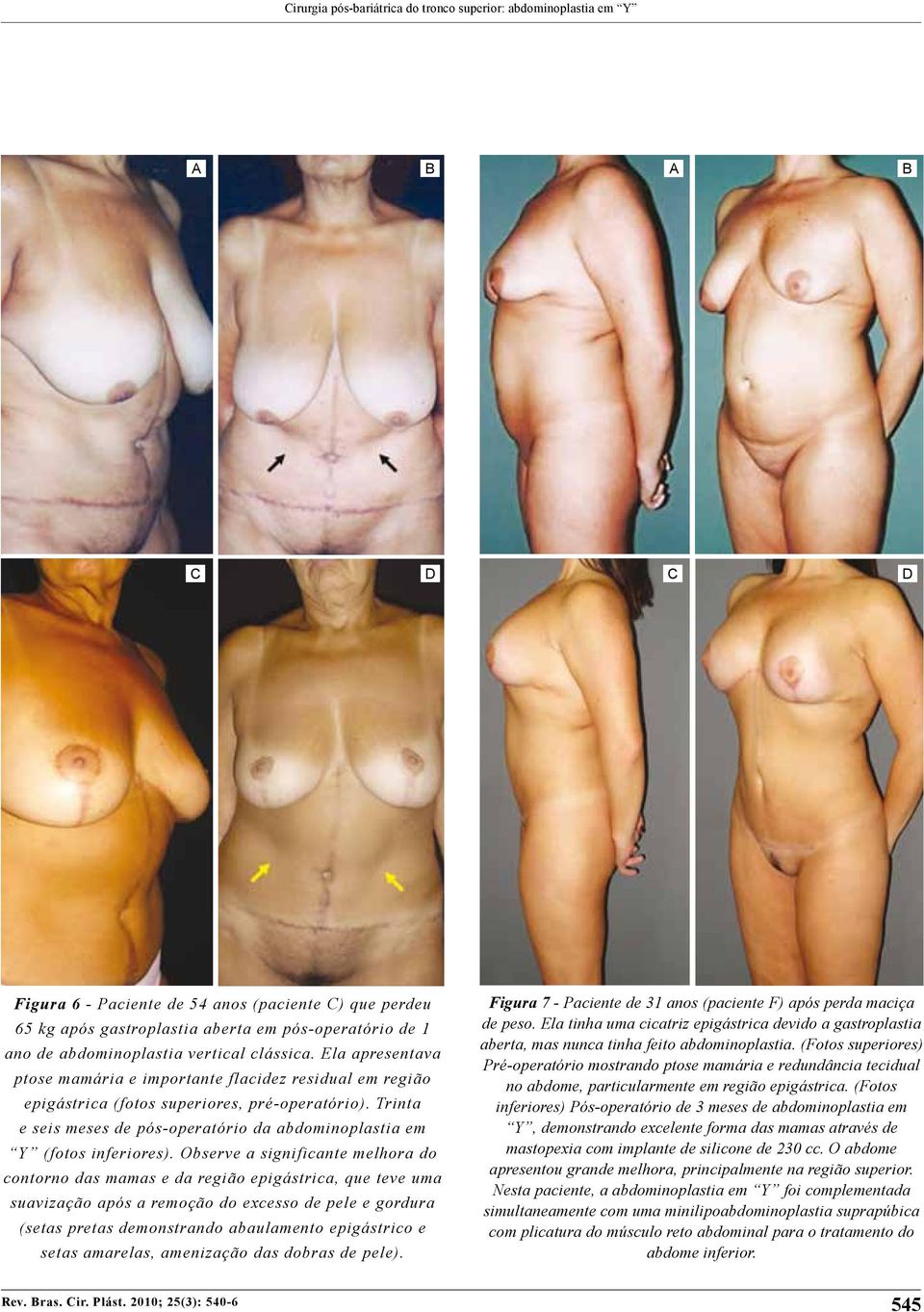 Trinta e seis meses de pós-operatório da abdominoplastia em Y (fotos inferiores).