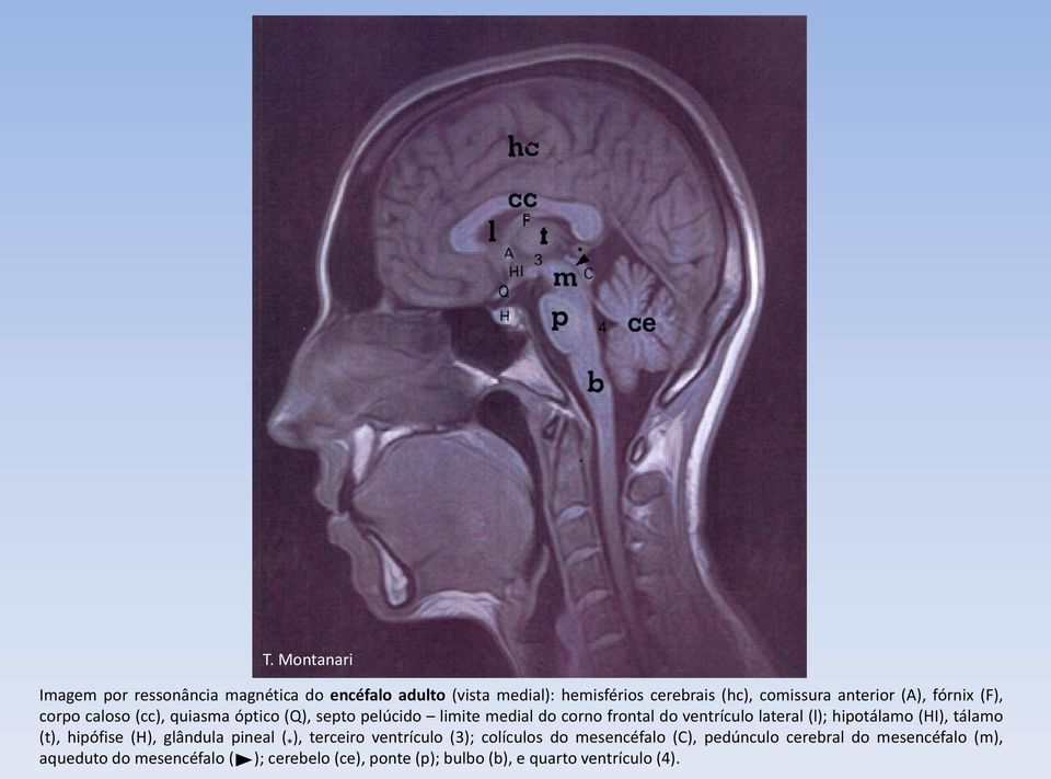 lateral (l); hipotálamo (HI), tálamo (t), hipófise (H), glândula pineal ( * ), terceiro ventrículo (3); colículos do
