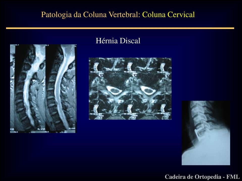 Vertebral: 