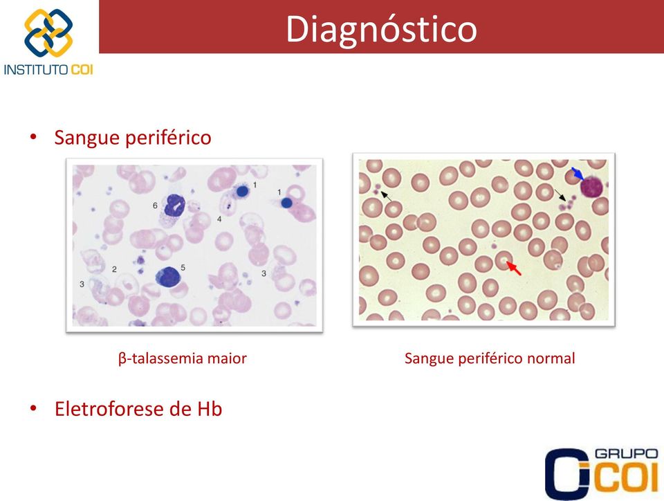 β-talassemia maior