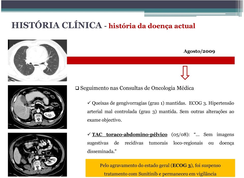 TAC toraco-abdomino-pélvico (05/08): Sem imagens sugestivas de recidivas tumorais loco-regionais