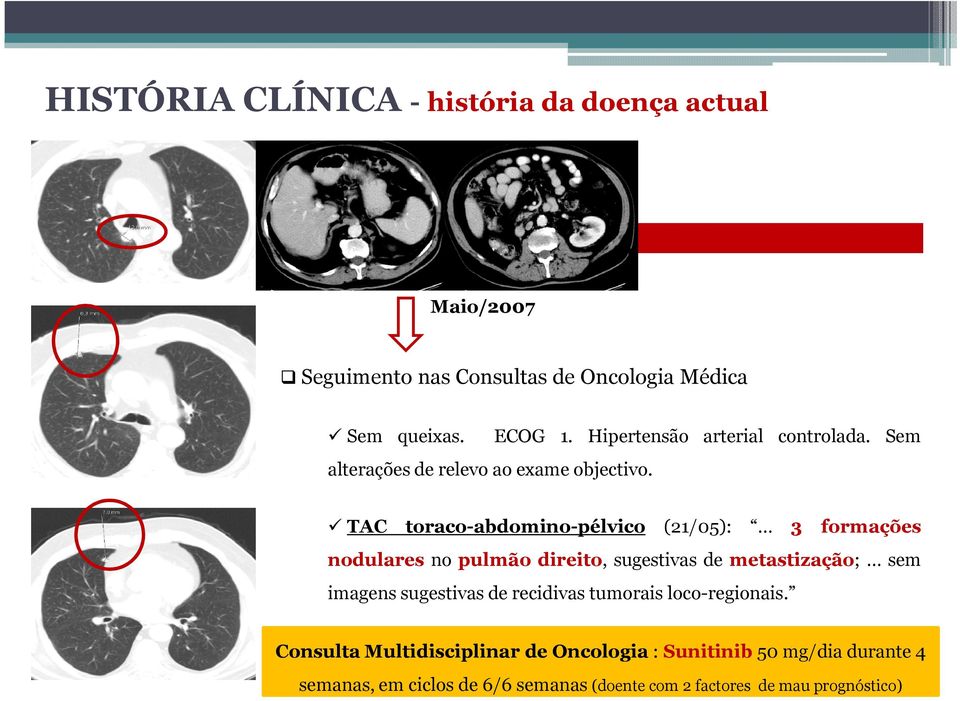TAC toraco-abdomino-pélvico (21/05): 3 formações nodulares no pulmão direito, sugestivas de metastização;