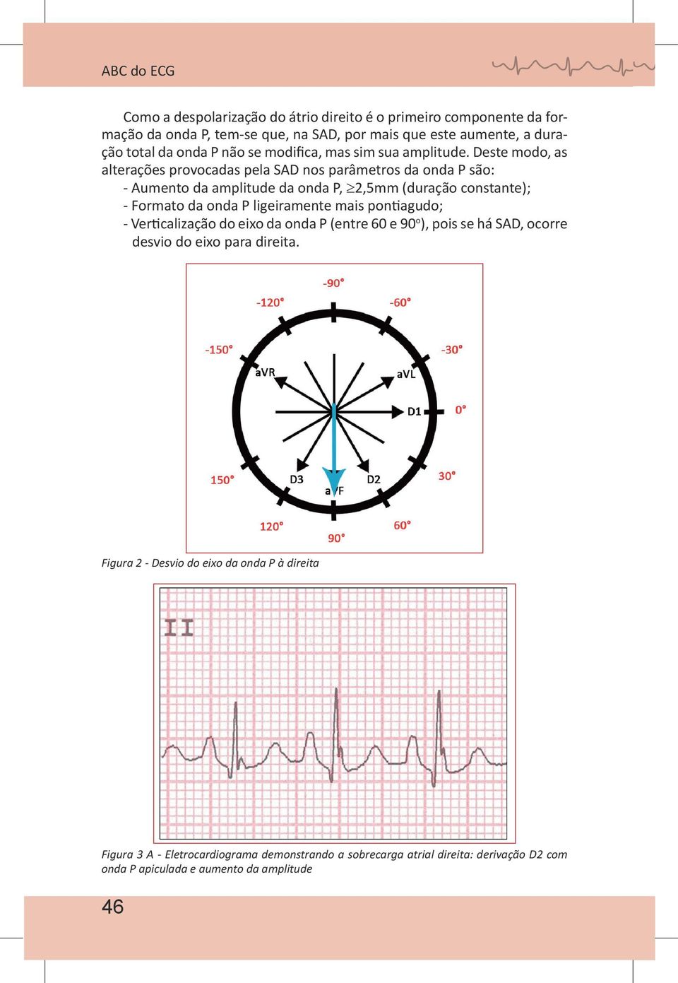 Deste modo, as alterações provocadas pela SAD nos parâmetros da onda P são: - Aumento da amplitude da onda P, 2,5mm (duração constante); - Formato da onda P ligeiramente