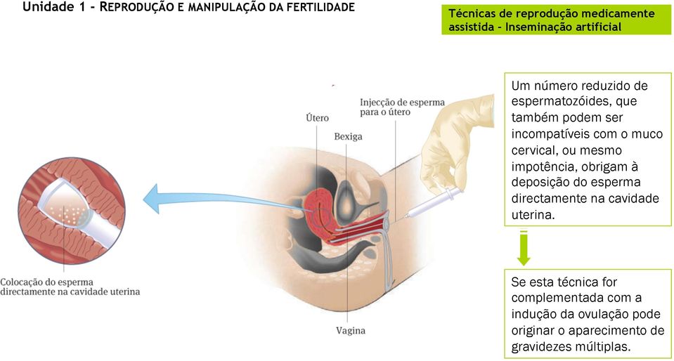 impotência, obrigam à deposição do esperma directamente na cavidade uterina.