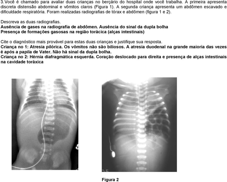 Ausência de gases na radiografia de abdômen.