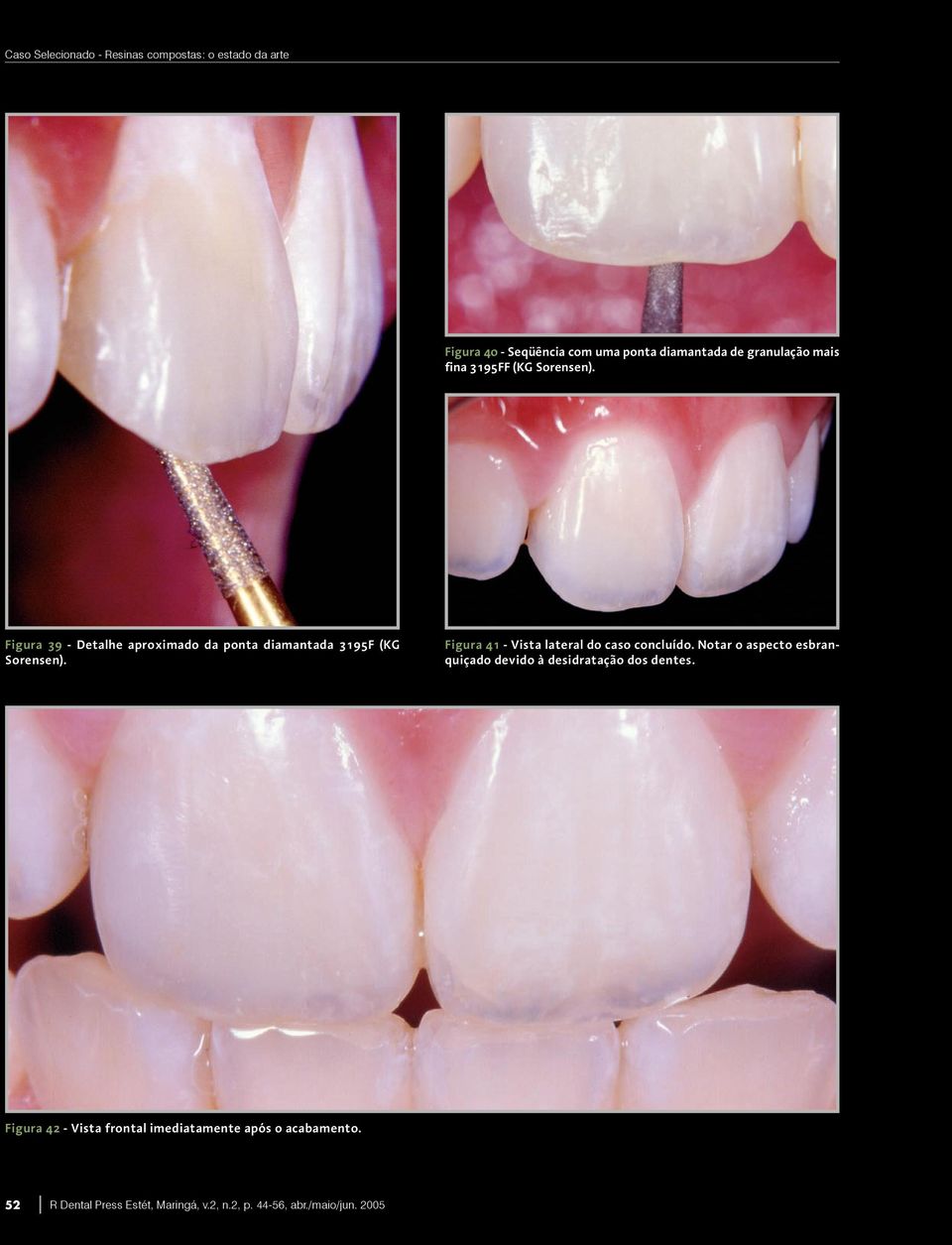 Figura 41 - Vista lateral do caso concluído. Notar o aspecto esbranquiçado devido à desidratação dos dentes.