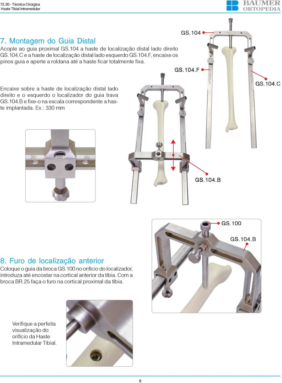 : 330 mm GS.104.C GS.104.B GS.100 GS.104.B 8. Furo de localização anterior Coloque o guia da broca GS.100 no orifício do localizador, introduza até encostar na cortical anterior da tíbia.