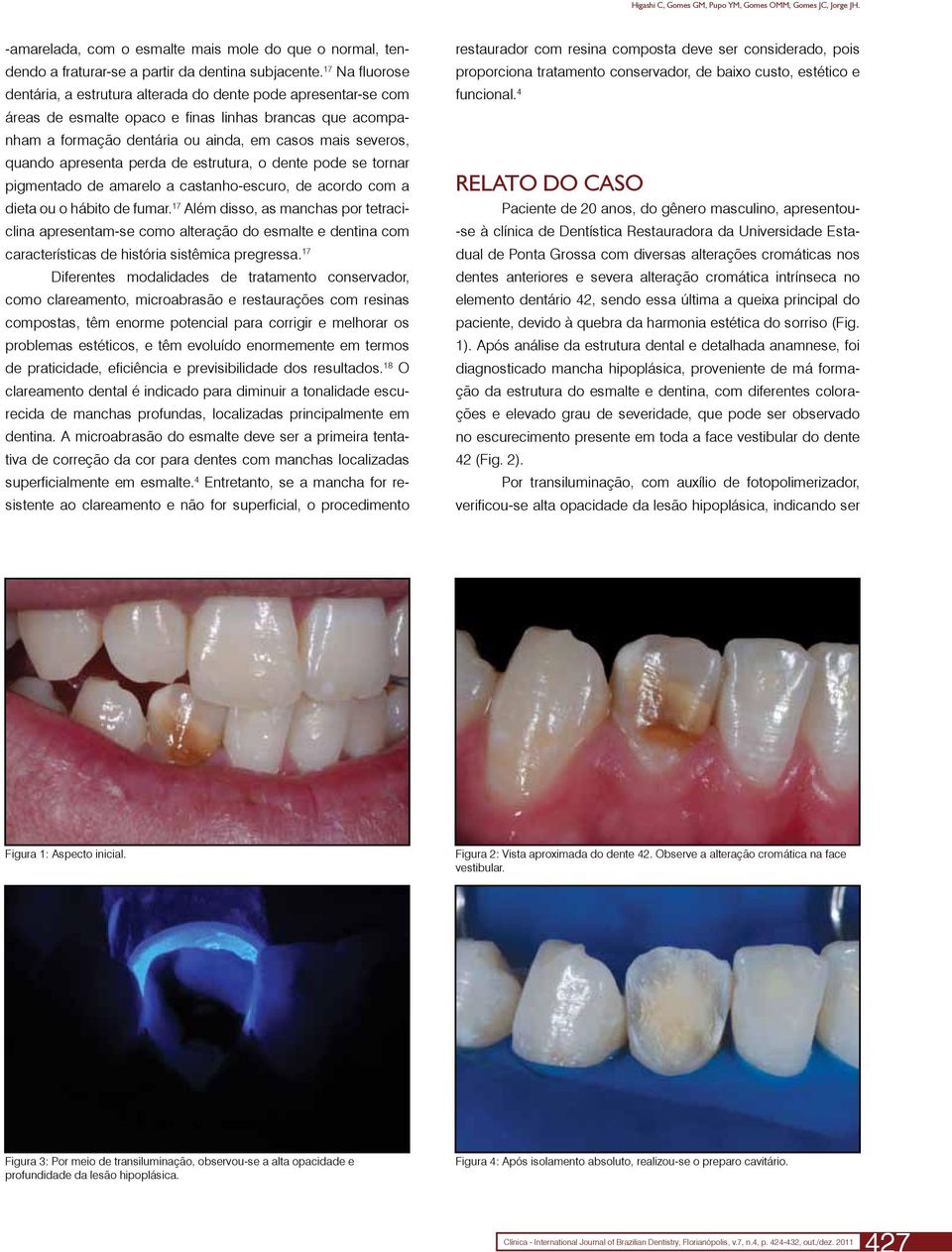 apresenta perda de estrutura, o dente pode se tornar pigmentado de amarelo a castanho-escuro, de acordo com a dieta ou o hábito de fumar.