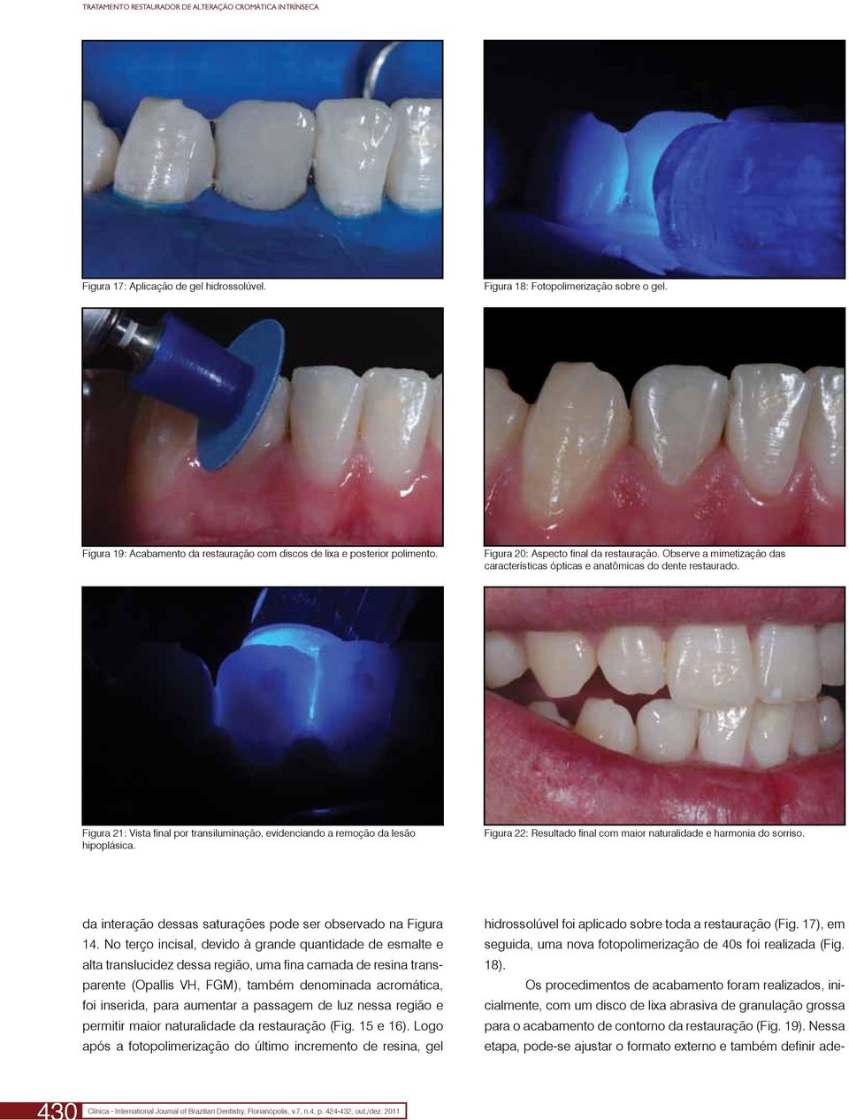 Observe a mimetização das características ópticas e anatômicas do dente restaurado. Figura 21: Vista final por transiluminação, evidenciando a remoção da lesão hipoplásica.