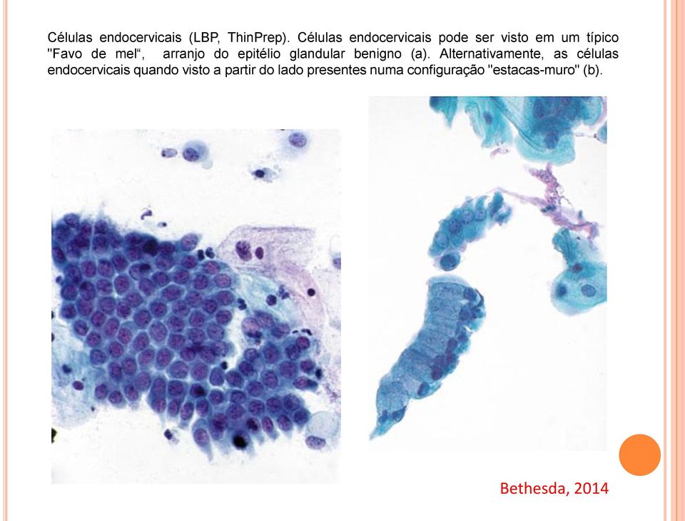 arranjo do epitélio glandular benigno (a).