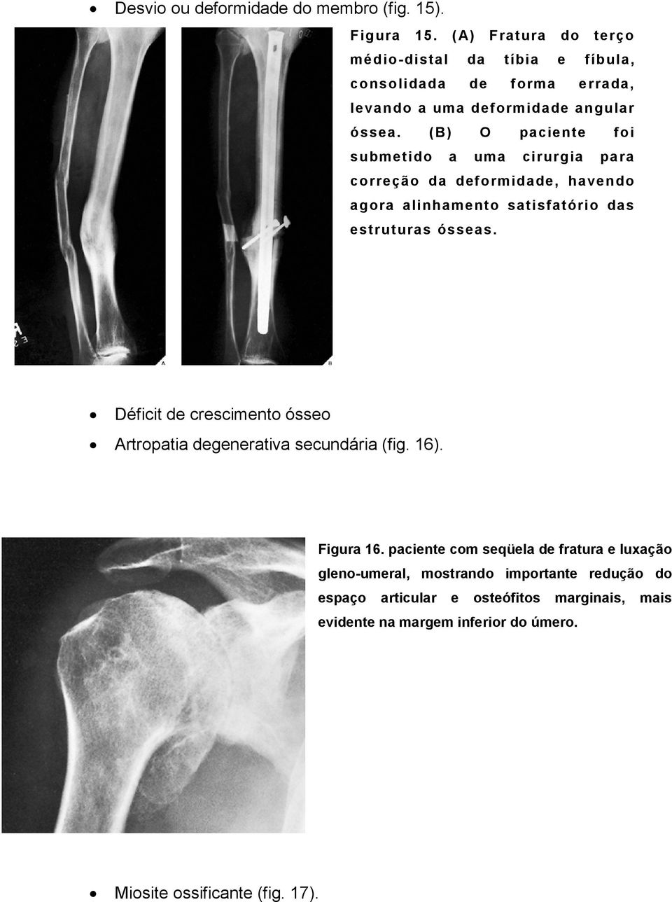 (B) O paciente foi submetido a uma cirurgia para correção da deformidade, havendo agora alinhamento satisfatório das estruturas ósseas.