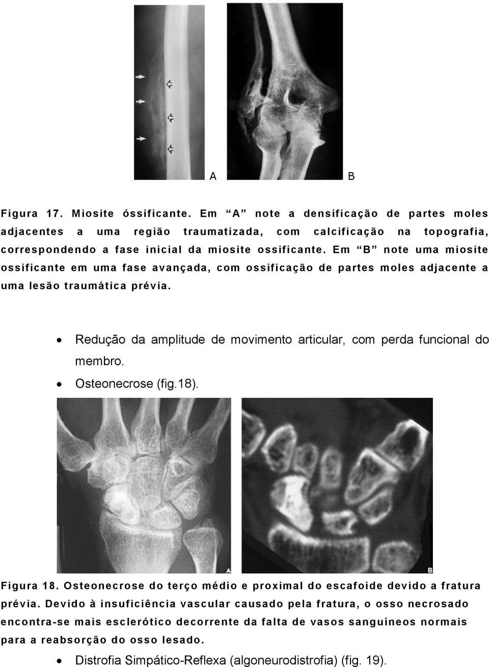 Em B note uma miosite ossificante em uma fase avançada, com ossificação de partes moles adjacente a uma lesão traumática prévia.