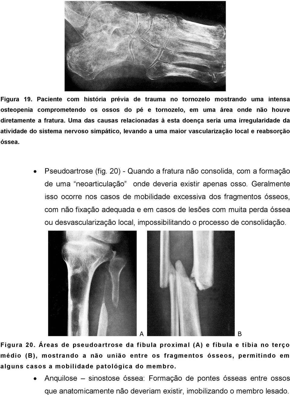 20) - Quando a fratura não consolida, com a formação de uma neoarticulação onde deveria existir apenas osso.