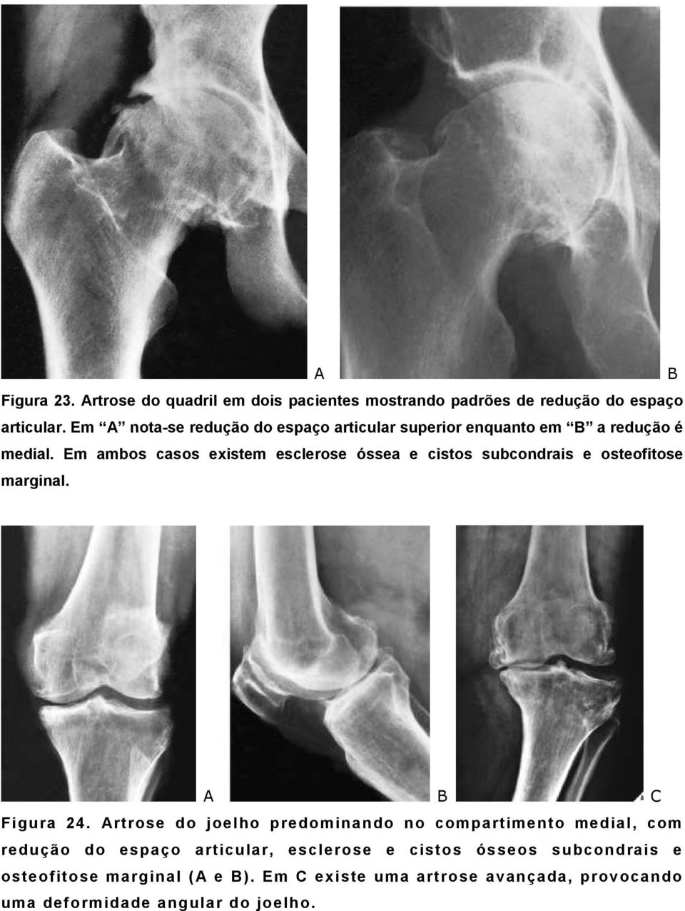 Em ambos casos existem esclerose óssea e cistos subcondrais e osteofitose marginal. A B C Figura 24.