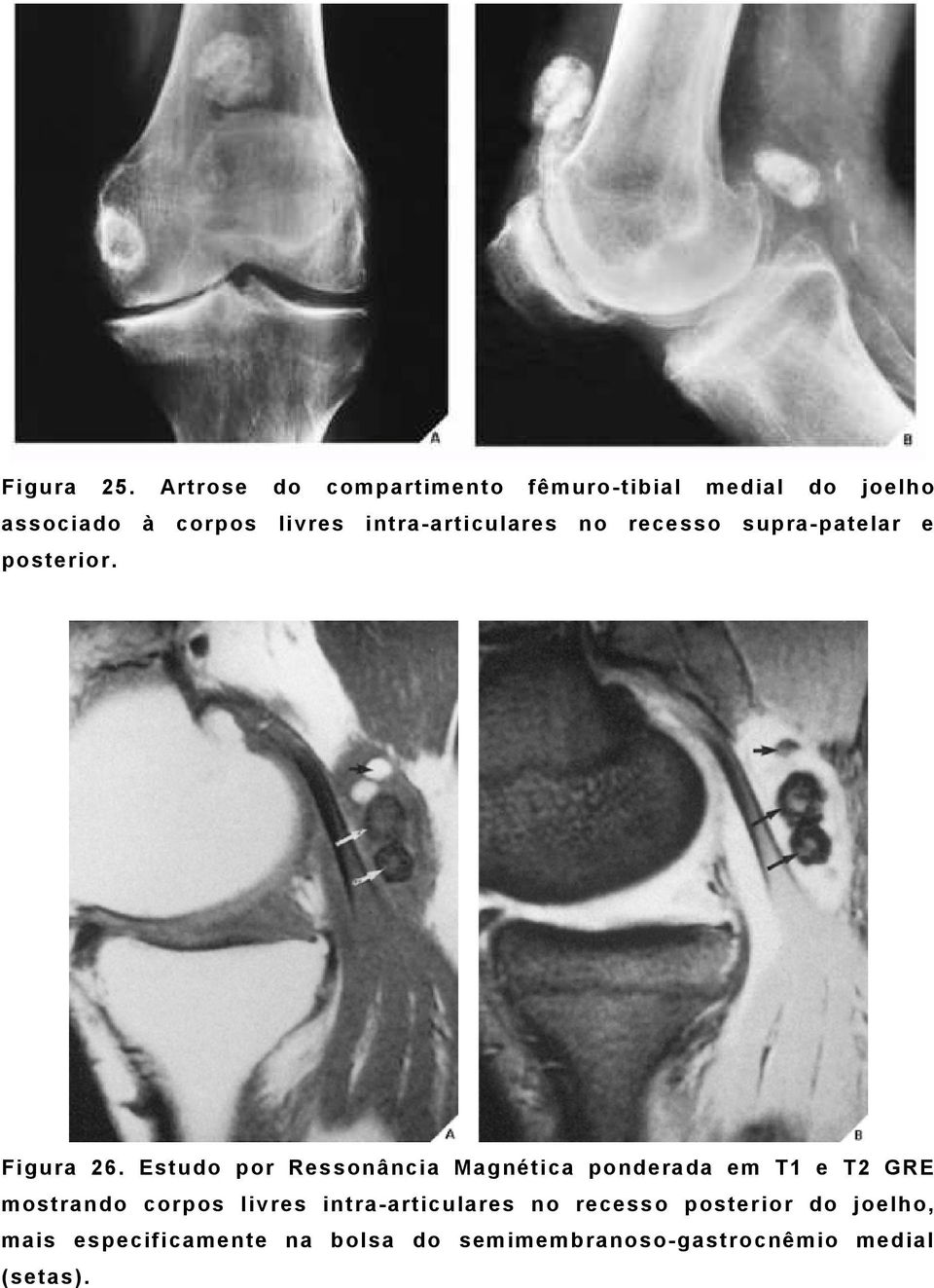 intra-articulares no recesso supra-patelar e posterior. Figura 26.