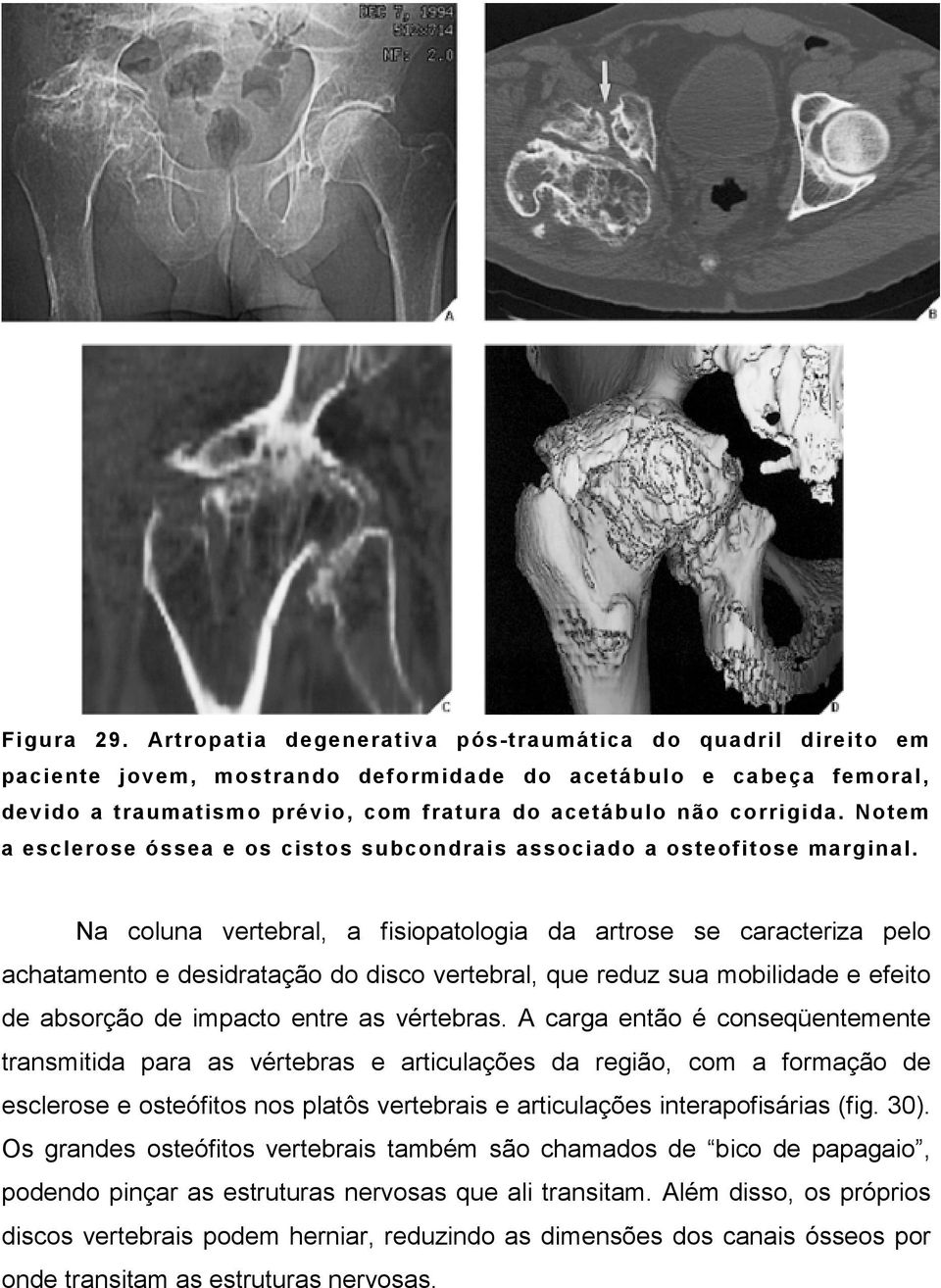 Notem a esclerose óssea e os cistos subcondrais associado a osteofitose marginal.