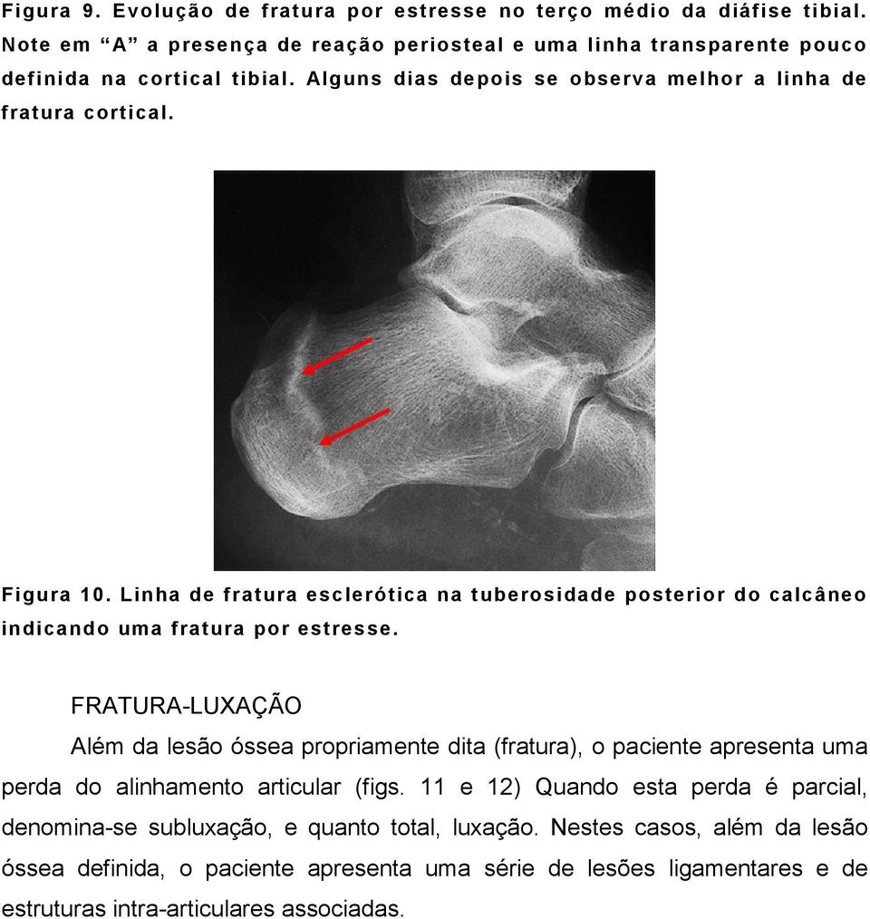 FRATURA-LUXAÇÃO Além da lesão óssea propriamente dita (fratura), o paciente apresenta uma perda do alinhamento articular (figs.