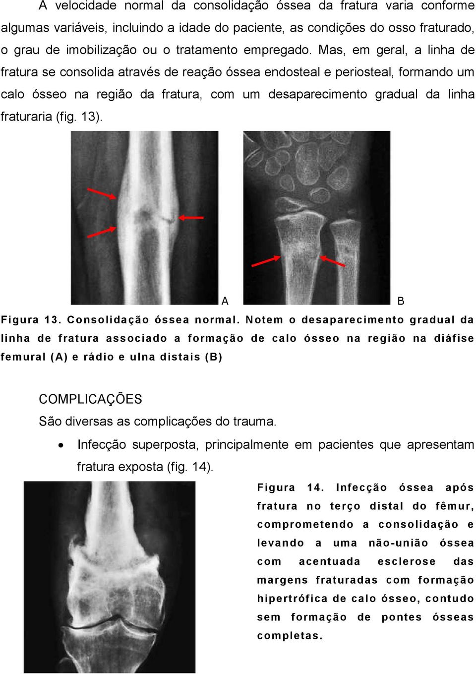 13). A B Figura 13. Consolidação óssea normal.