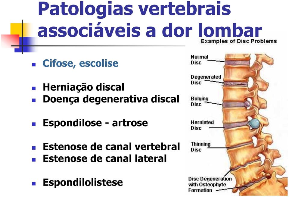 degenerativa discal Espondilose - artrose