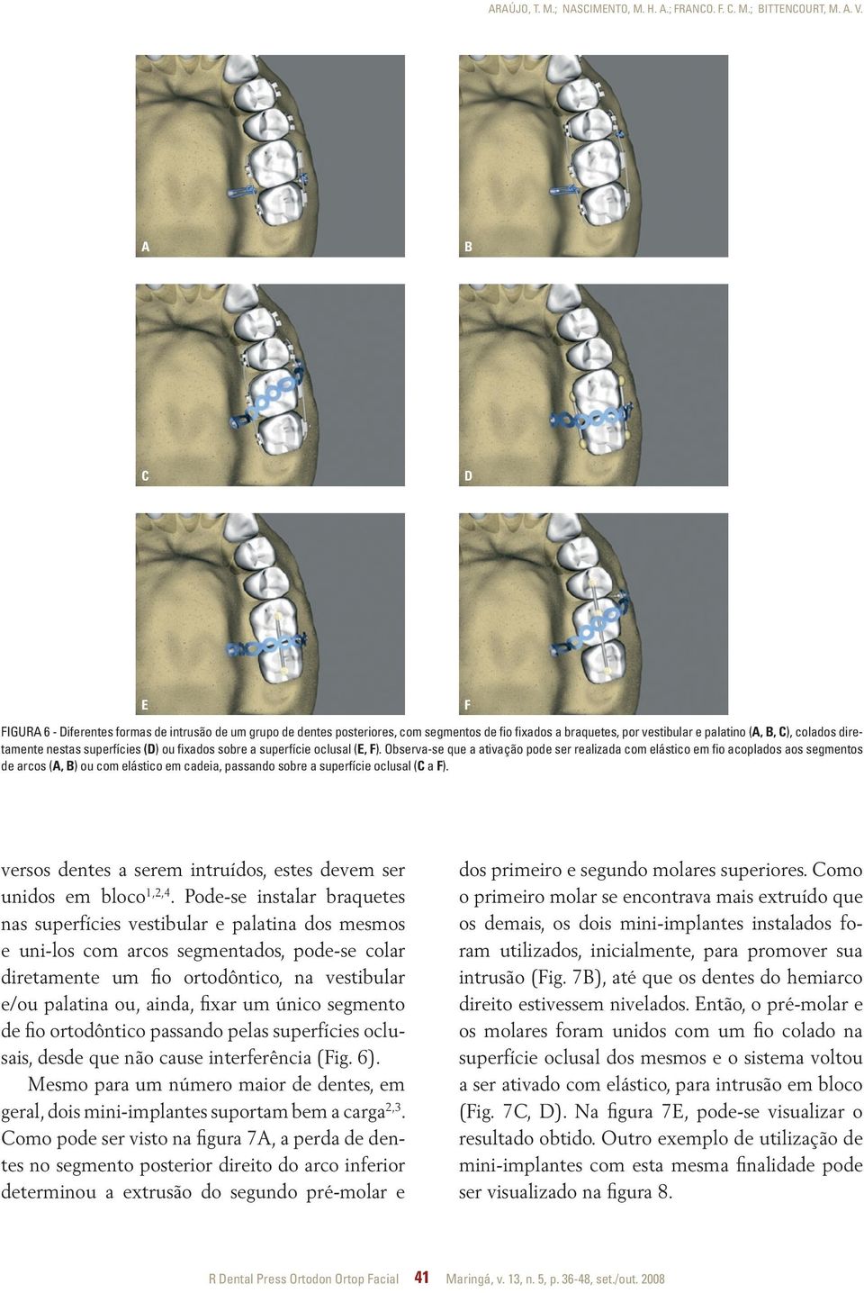 (D) ou fixados sobre a superfície oclusal (E, F).