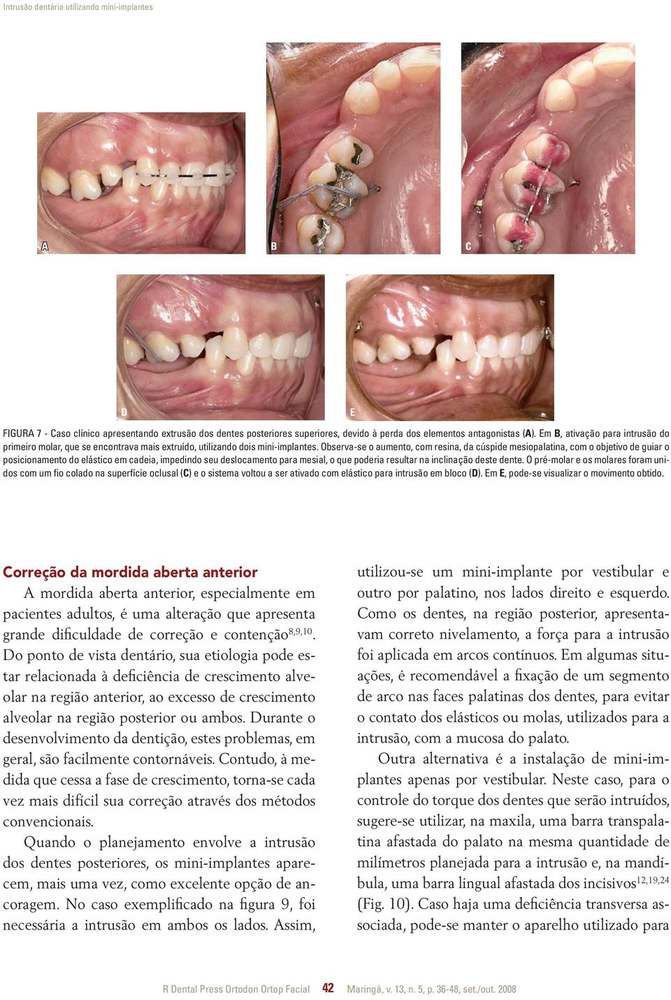 Observa-se o aumento, com resina, da cúspide mesiopalatina, com o objetivo de guiar o posicionamento do elástico em cadeia, impedindo seu deslocamento para mesial, o que poderia resultar na