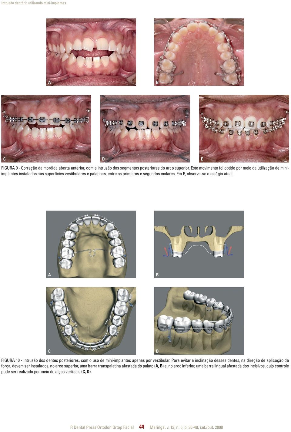 C D FIGUR 10 - Intrusão dos dentes posteriores, com o uso de mini-implantes apenas por vestibular.