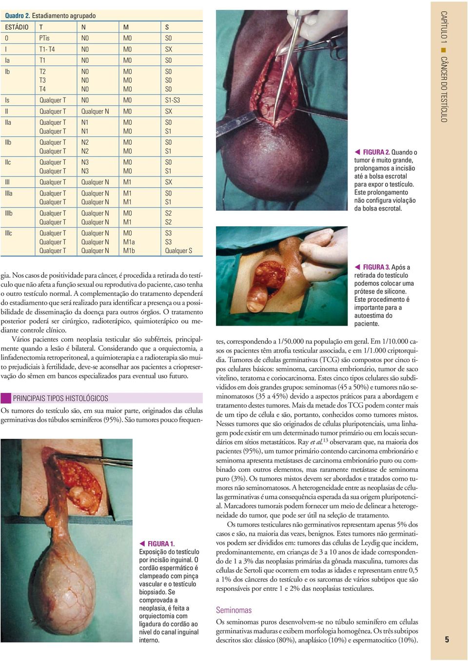 S3 S3 Qualquer S FIGURA 2. Quando o tumor émuitogrande, prolongamos a incisão até a bolsa escrotal para expor o testículo. Este prolongamento não configura violação da bolsa escrotal.