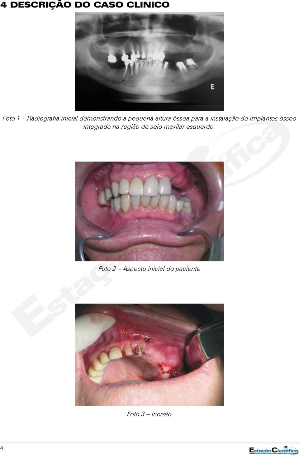 implantes ósseo integrado na região de seio maxilar