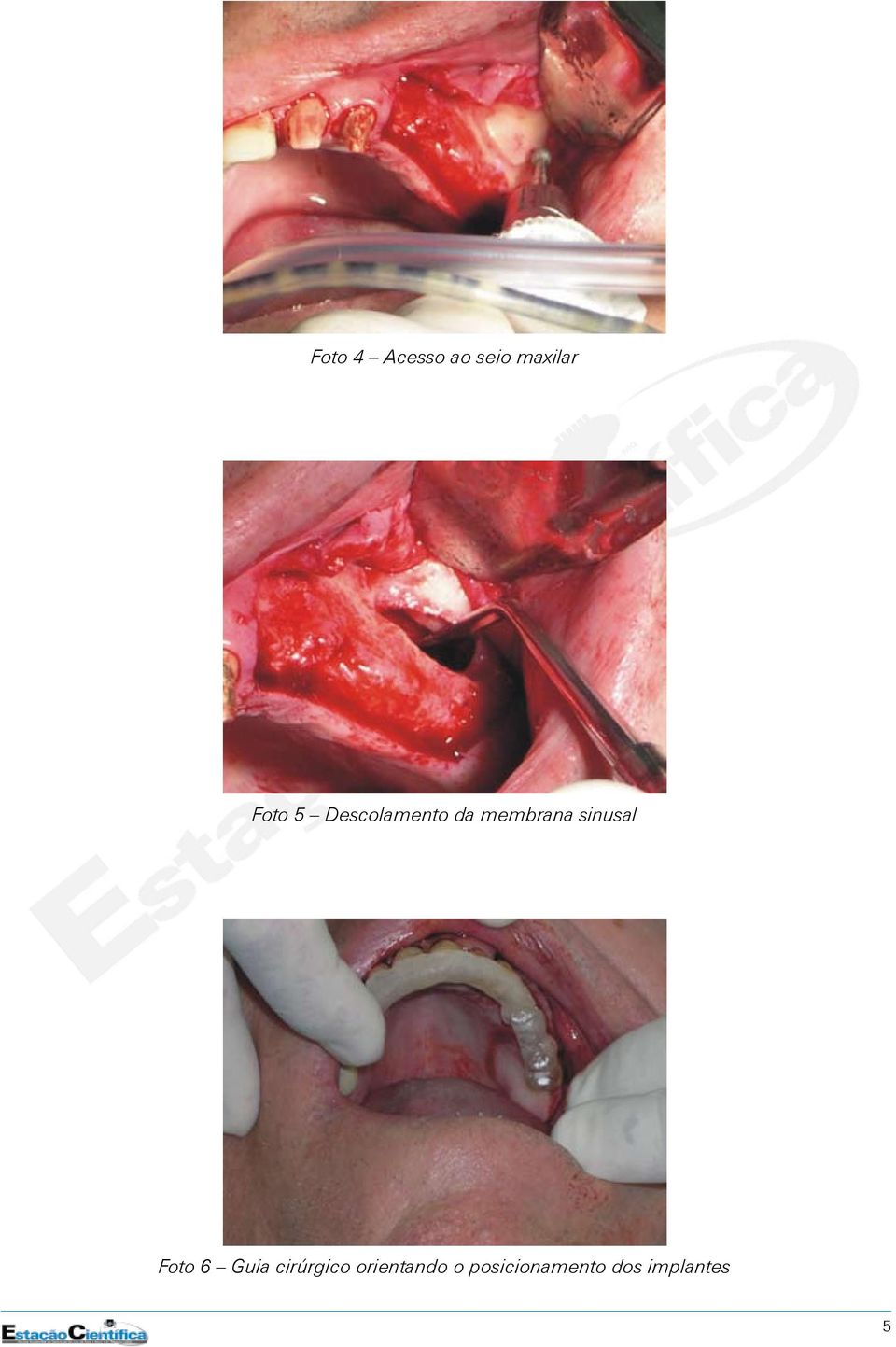 sinusal Foto 6 Guia cirúrgico