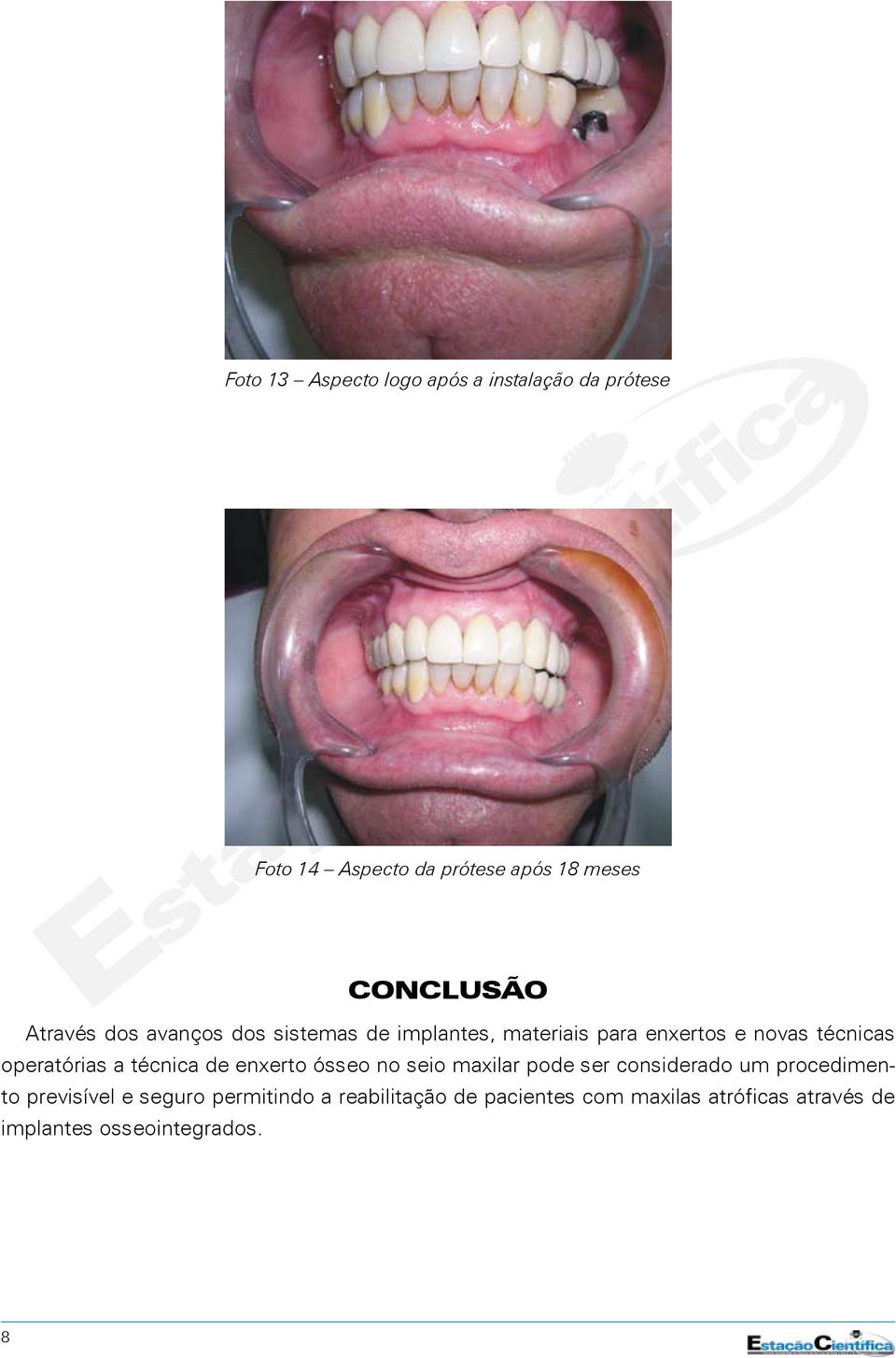 a técnica de enxerto ósseo no seio maxilar pode ser considerado um procedimento previsível e seguro