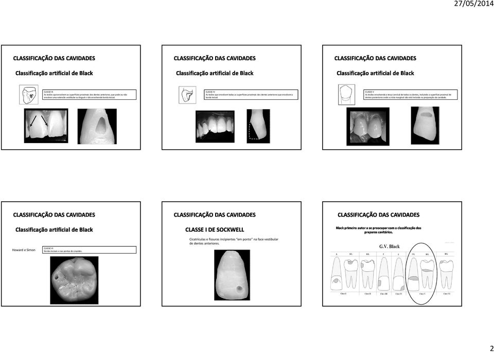 CLASSE V As lesões envolvendo o terço cervical de todos os dentes, incluindo a superfície proximal de dentes posteriores onde a crista marginal não está