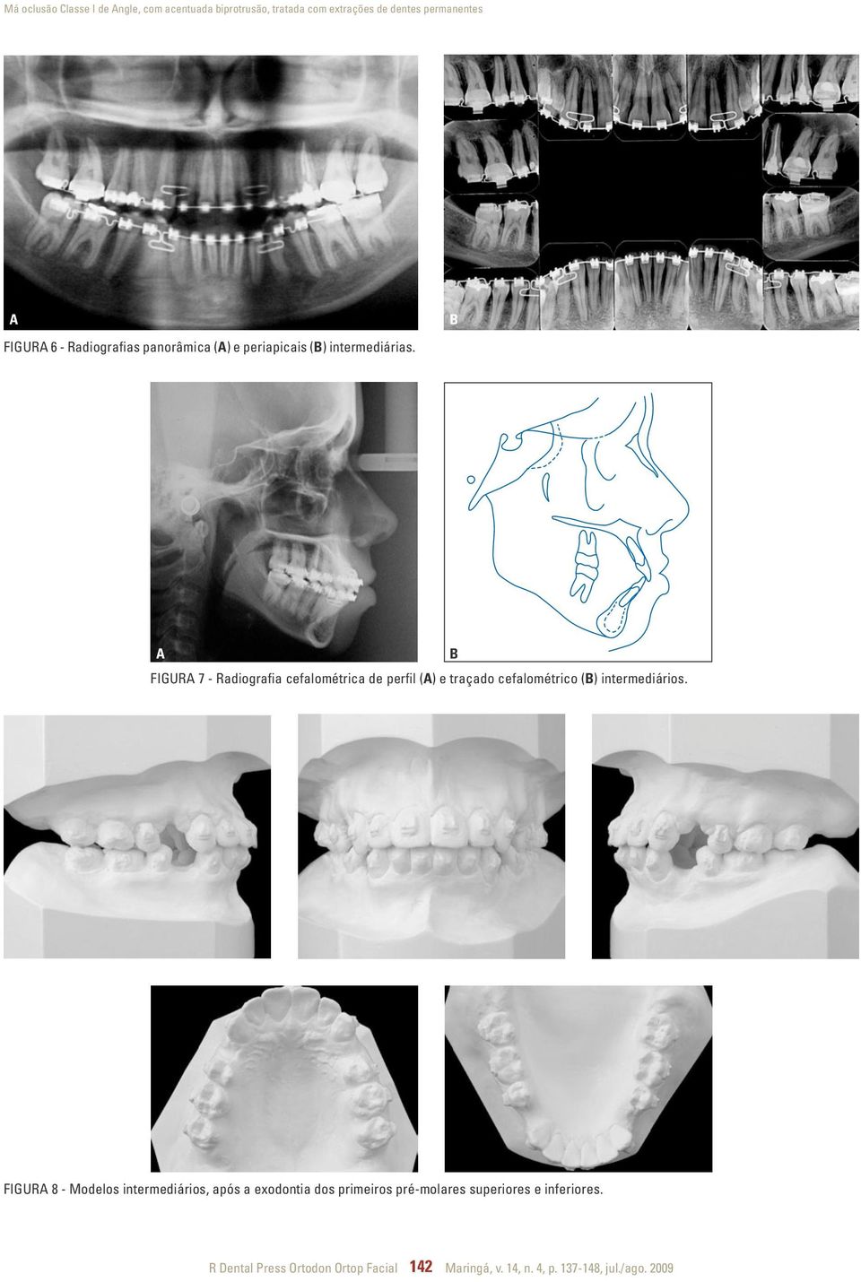 FIGUR 7 - Radiografia cefalométrica de perfil () e traçado cefalométrico () intermediários.