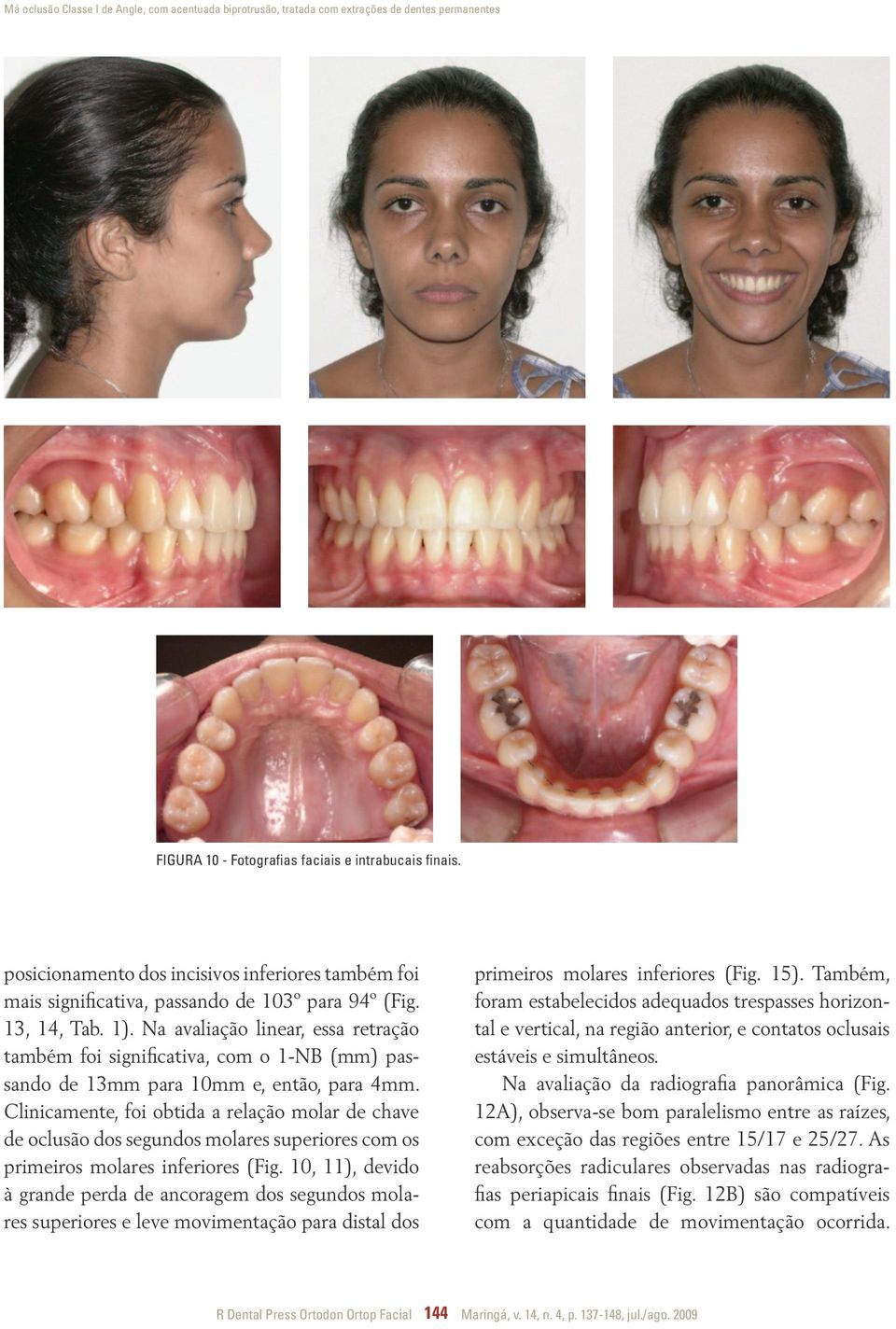 Na avaliação linear, essa retração também foi significativa, com o 1-N (mm) passando de 13mm para 10mm e, então, para 4mm.