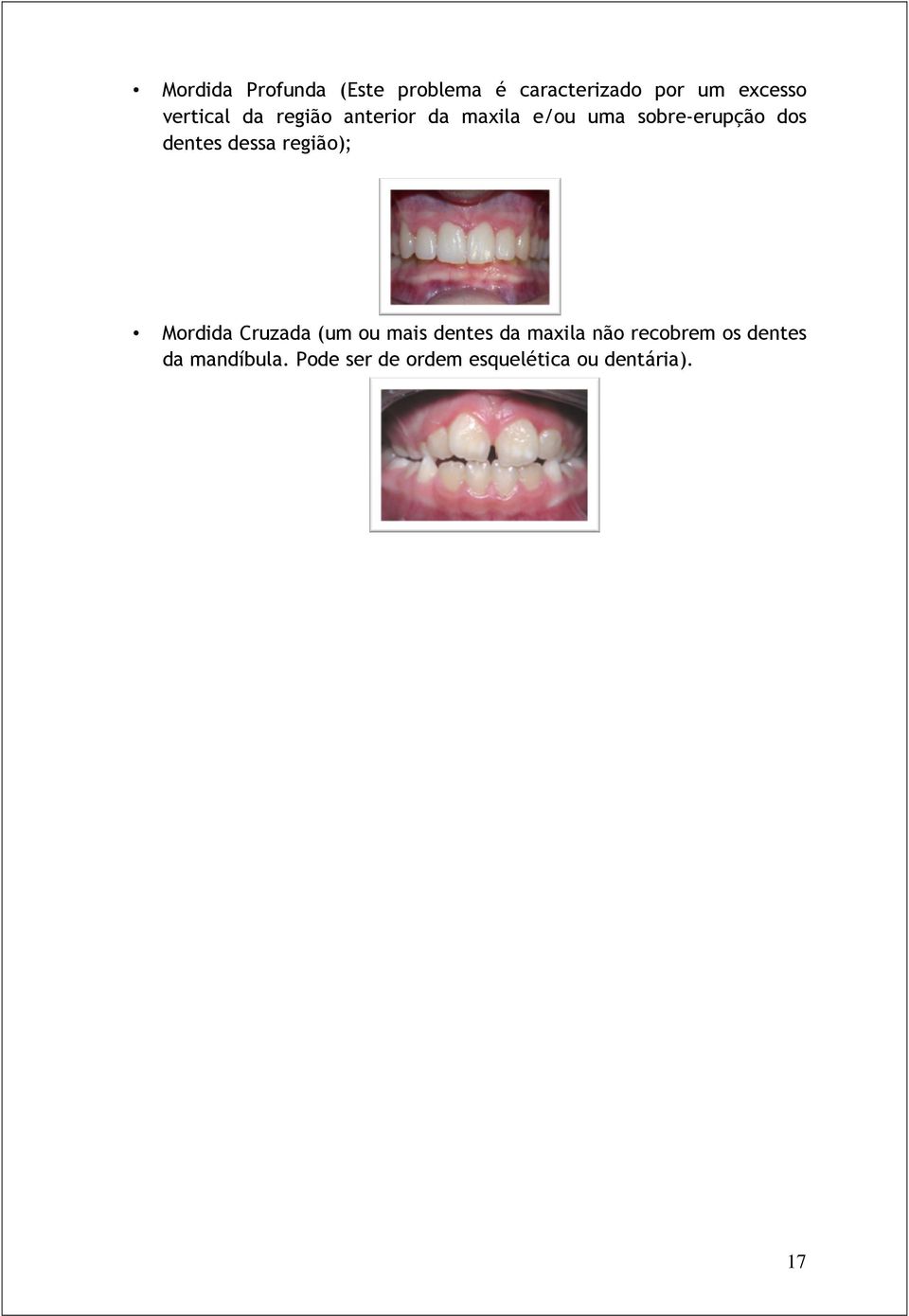 dentes dessa região); Mordida Cruzada (um ou mais dentes da maxila