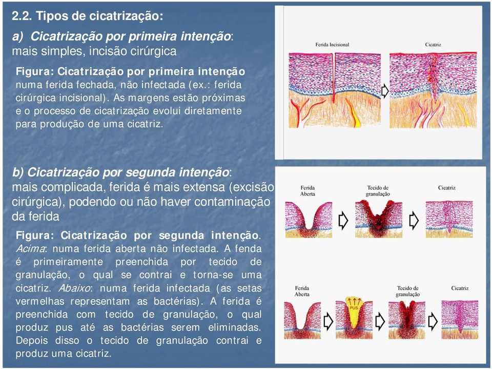 b) Cicatrização por segunda intenção: mais complicada, ferida é mais extensa (excisão cirúrgica), podendo ou não haver contaminação da ferida Figura: Cicatrização por segunda intenção.