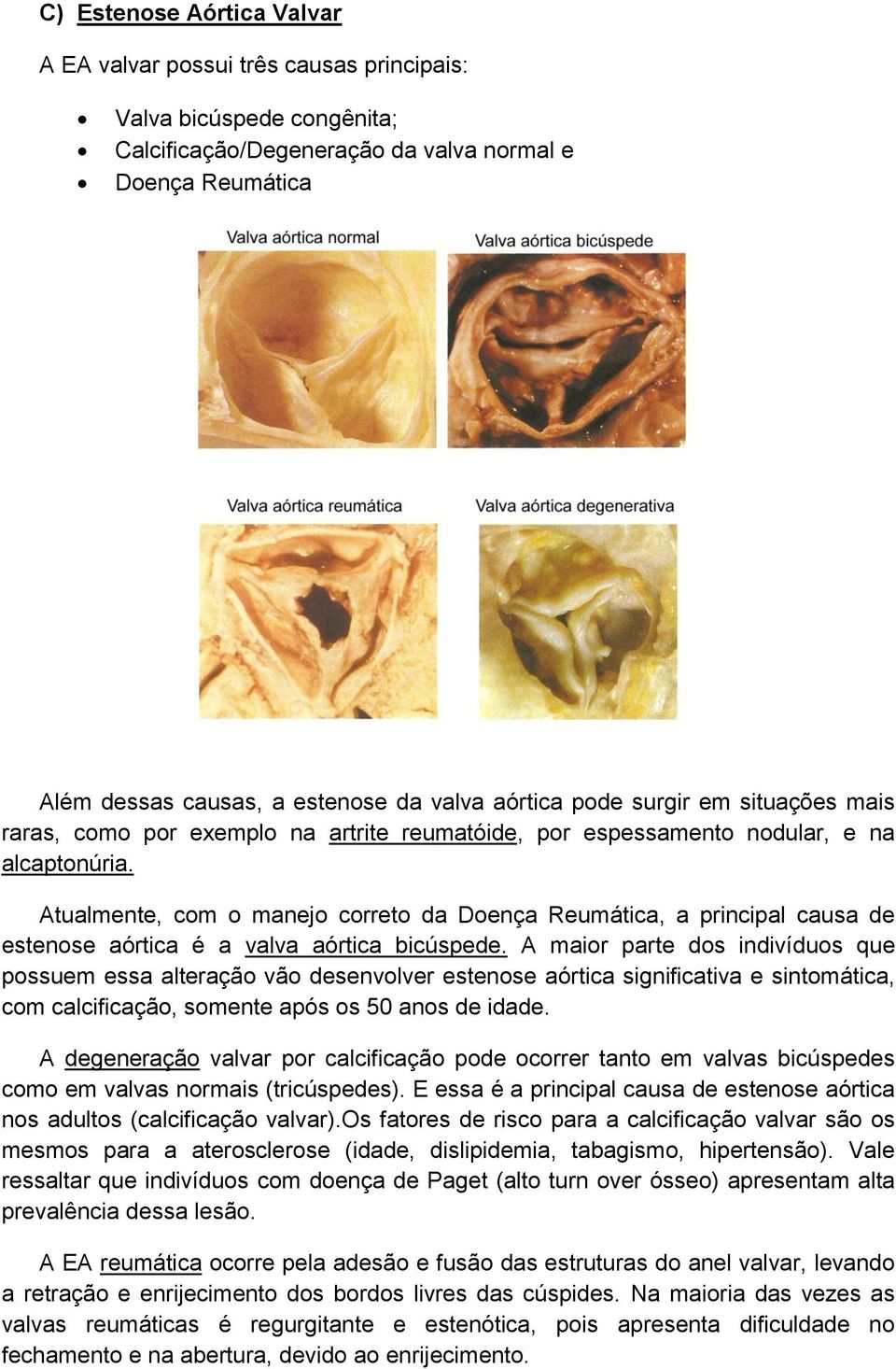 Atualmente, com o manejo correto da Doença Reumática, a principal causa de estenose aórtica é a valva aórtica bicúspede.