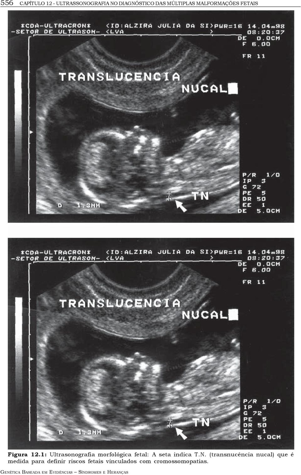 1: Ultrasonografia morfológica fetal: A seta indica T.N.