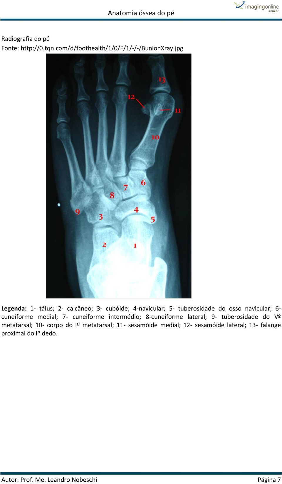 cuneiforme medial; 7- cuneiforme intermédio; 8-cuneiforme lateral; 9- tuberosidade do Vº metatarsal; 10-