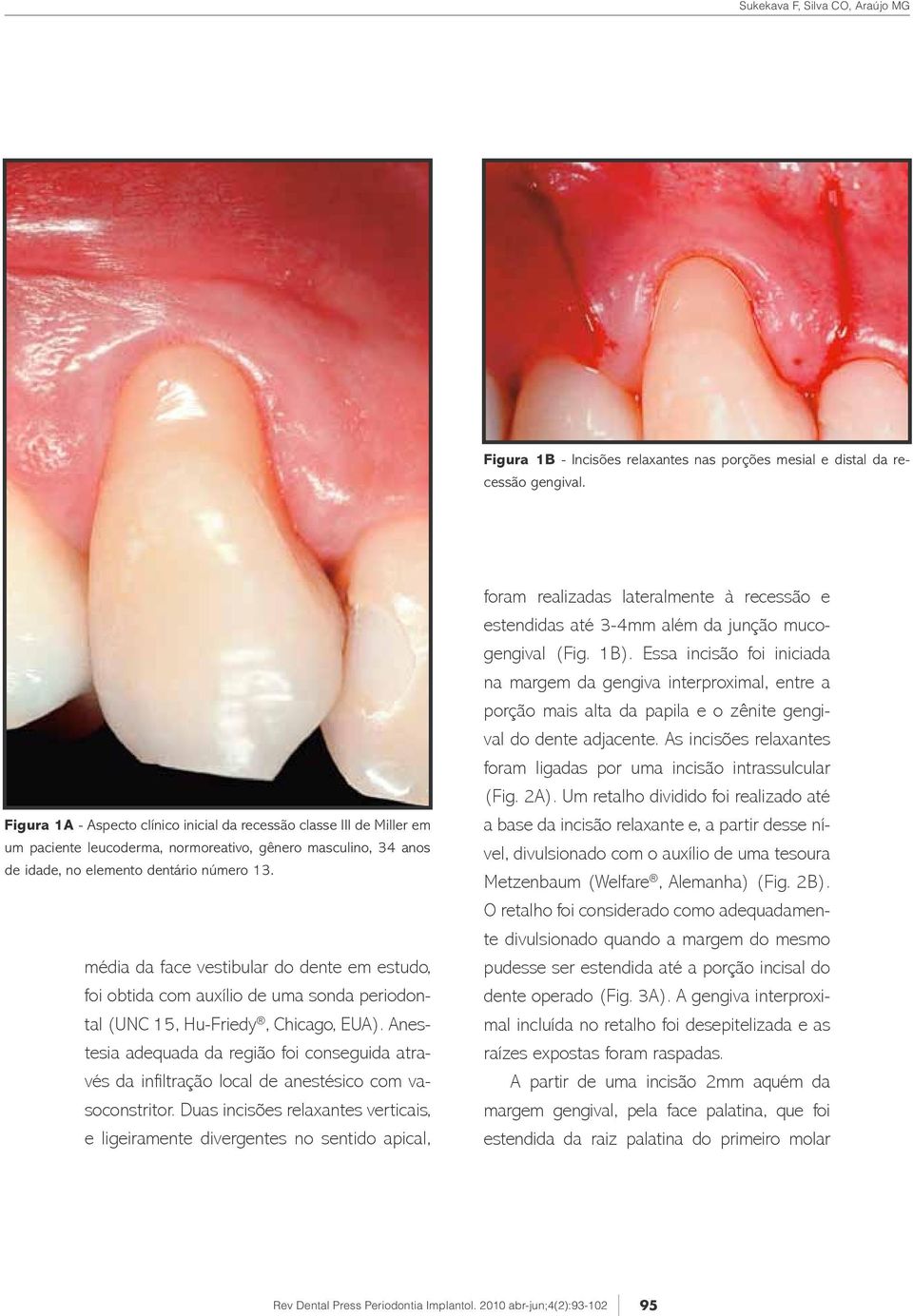 média da face vestibular do dente em estudo, foi obtida com auxílio de uma sonda periodontal (UNC 15, Hu-Friedy, Chicago, EUA).