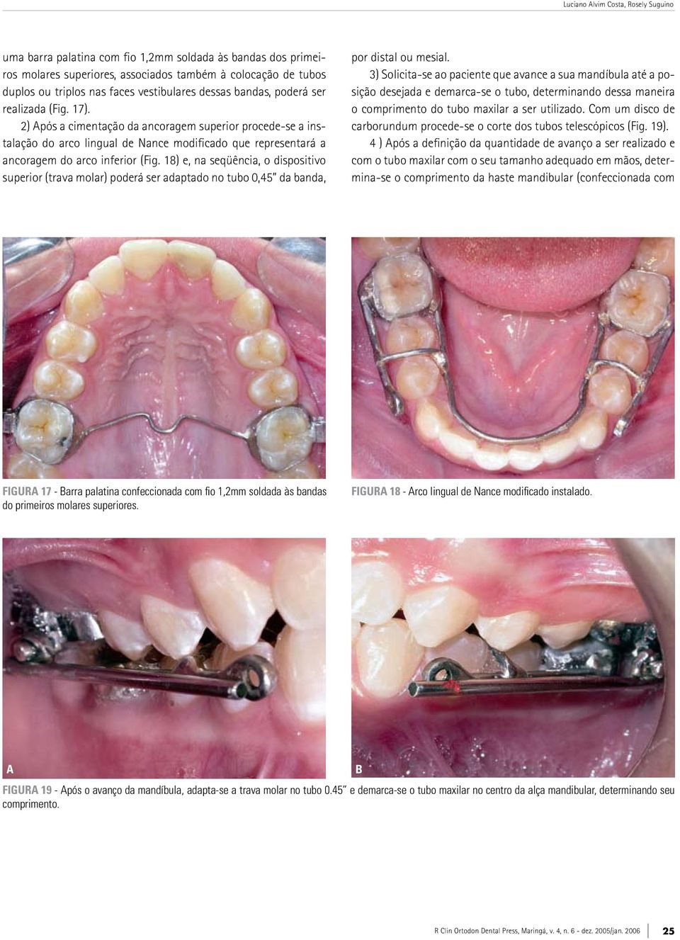 18) e, na seqüência, o dispositivo superior (trava molar) poderá ser adaptado no tubo 0,45 da banda, por distal ou mesial.