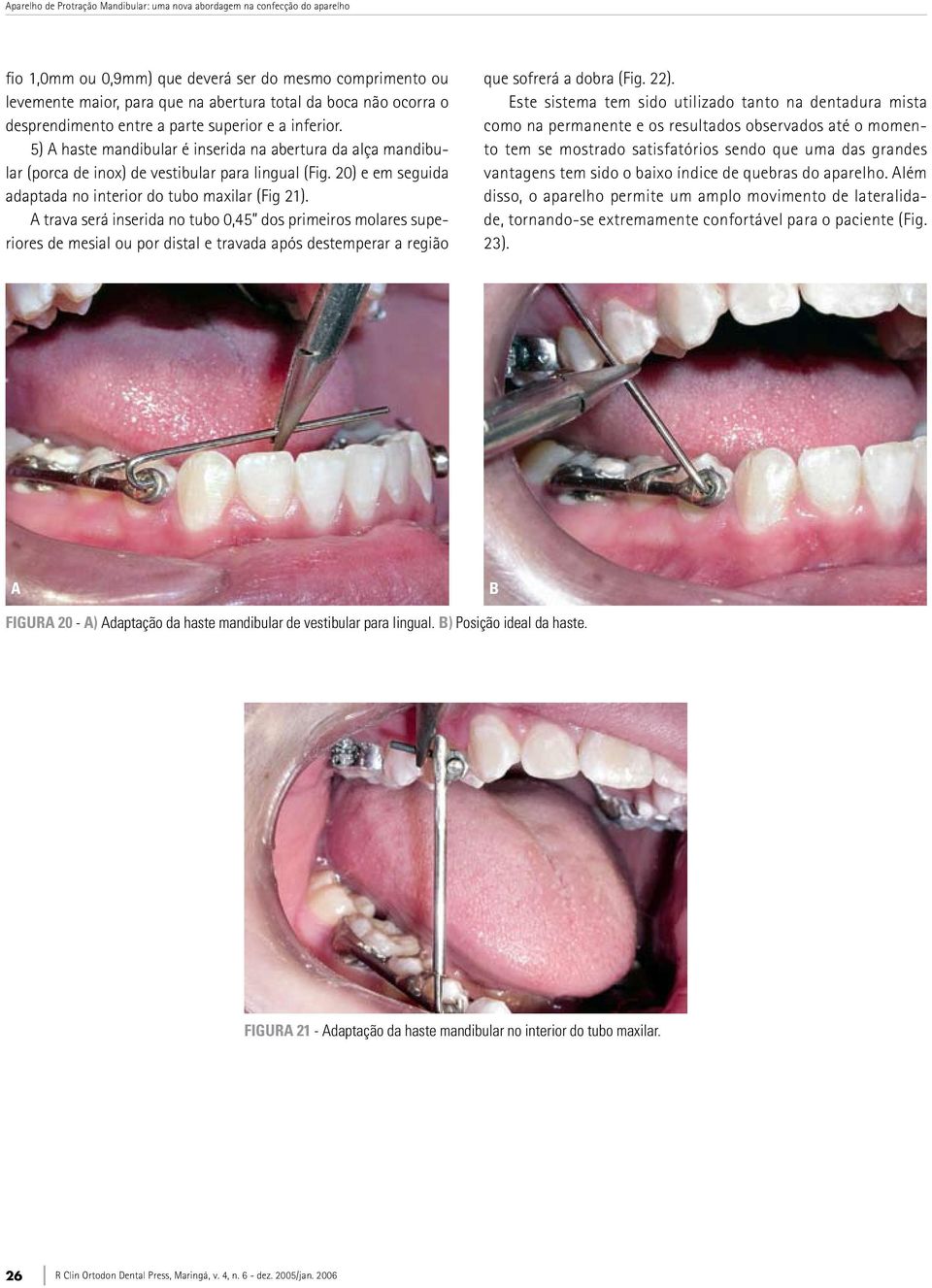 20) e em seguida adaptada no interior do tubo maxilar (Fig 21).