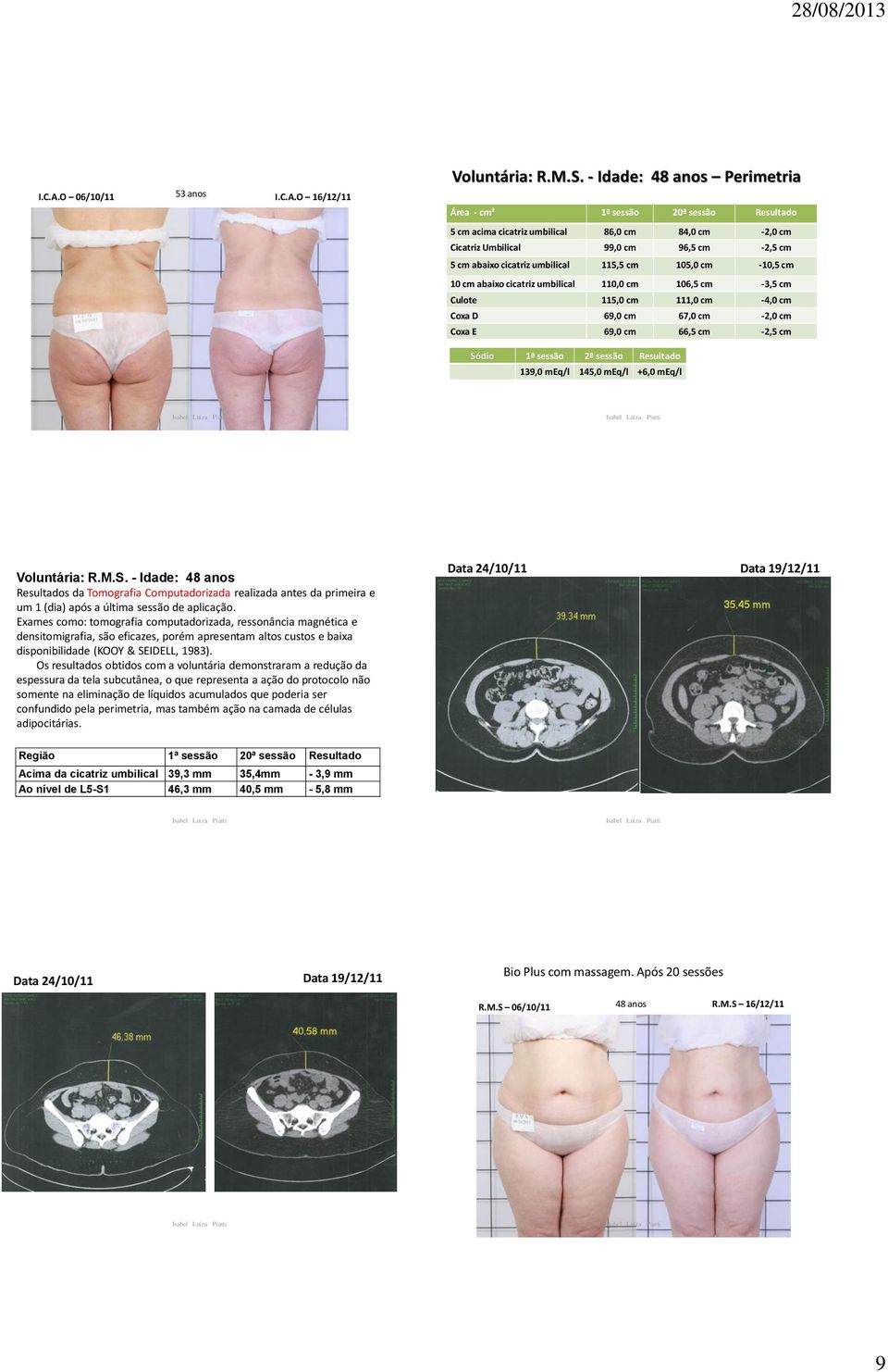 115,5 cm 105,0 cm -10,5 cm 10 cm abaixo cicatriz umbilical 110,0 cm 106,5 cm -3,5 cm Culote 115,0 cm 111,0 cm -4,0 cm Coxa D 69,0 cm 67,0 cm -2,0 cm Coxa E 69,0 cm 66,5 cm -2,5 cm Sódio 1ª sessão 2ª