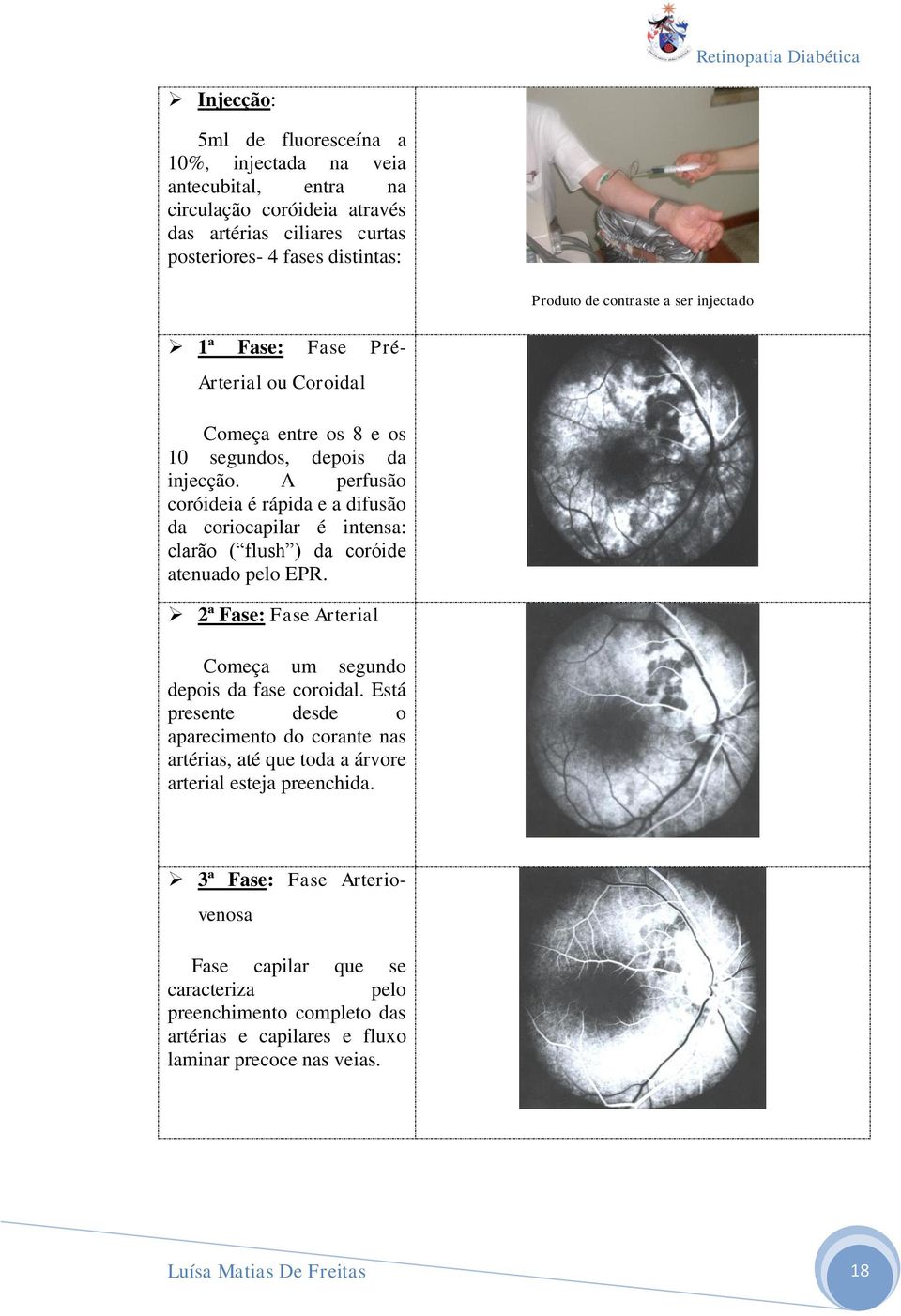 A perfusão coróideia é rápida e a difusão da coriocapilar é intensa: clarão ( flush ) da coróide atenuado pelo EPR. 2ª Fase: Fase Arterial Começa um segundo depois da fase coroidal.