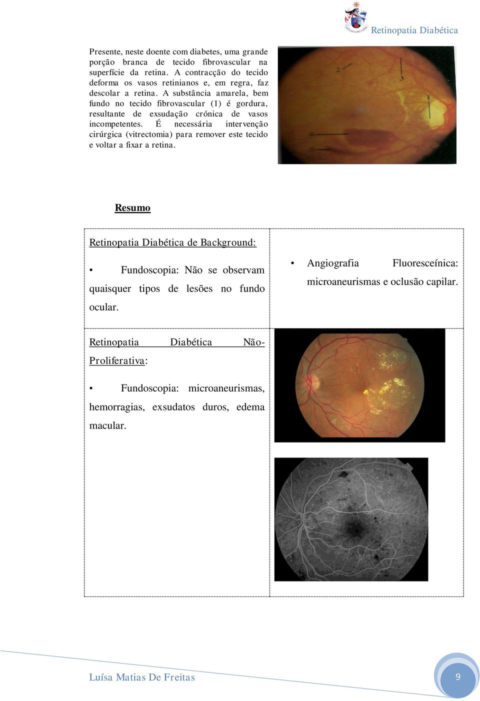 A substância amarela, bem fundo no tecido fibrovascular (1) é gordura, resultante de exsudação crónica de vasos incompetentes.