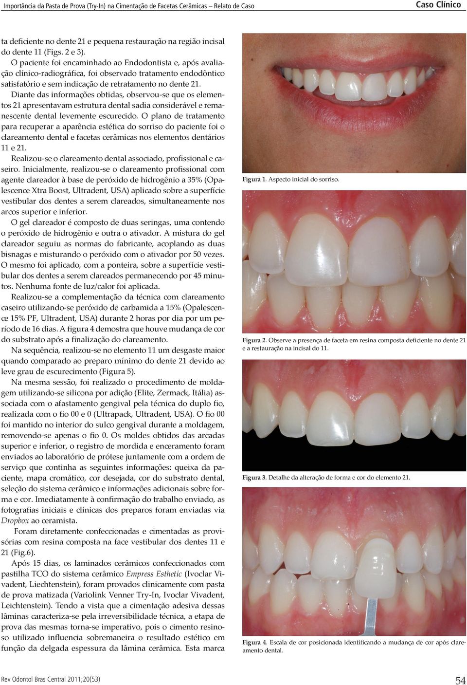 O plano de tratamento para recuperar a aparência estética do sorriso do paciente foi o clareamento dental e facetas cerâmicas nos elementos dentários 11 e 21.