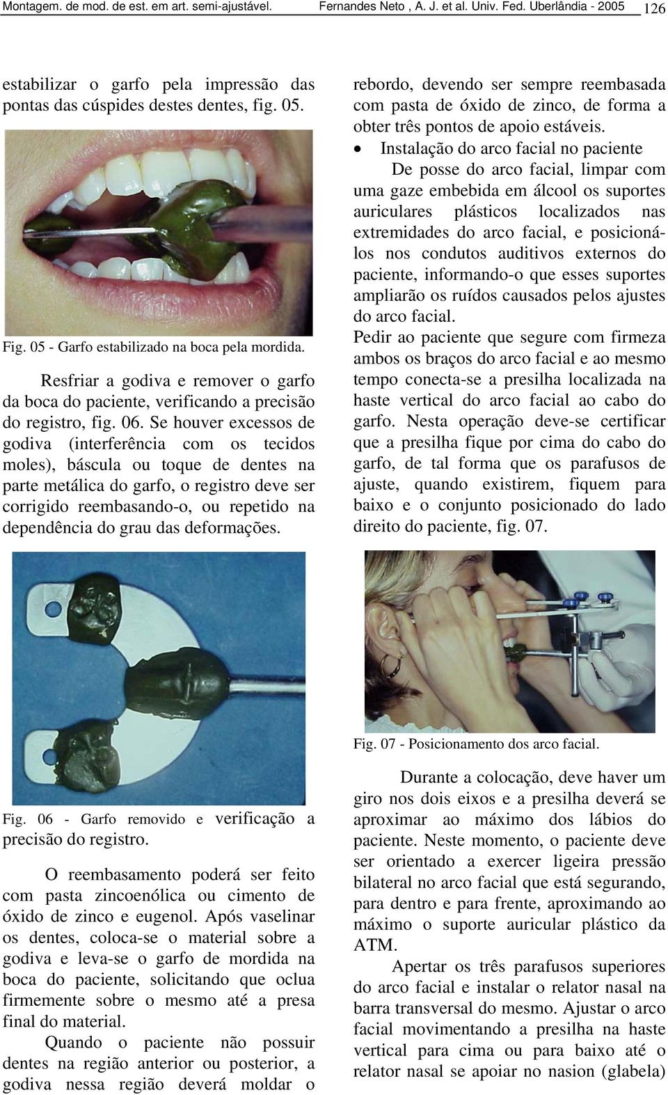 Se houver excessos de godiva (interferência com os tecidos moles), báscula ou toque de dentes na parte metálica do garfo, o registro deve ser corrigido reembasando-o, ou repetido na dependência do