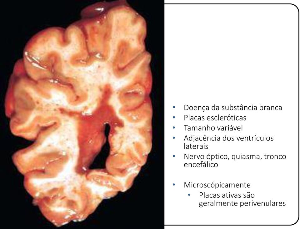 laterais Nervo óptico, quiasma, tronco encefálico
